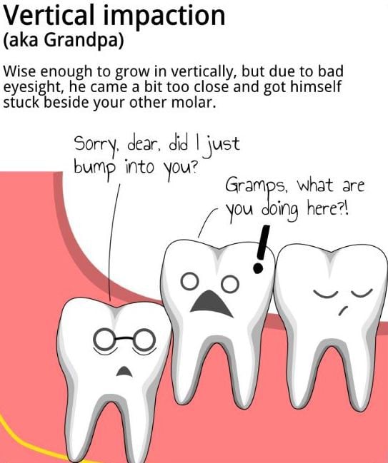 Fun Facts About Wisdom Teeth